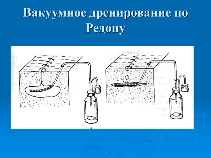 Вакуумное дренирование по Редону